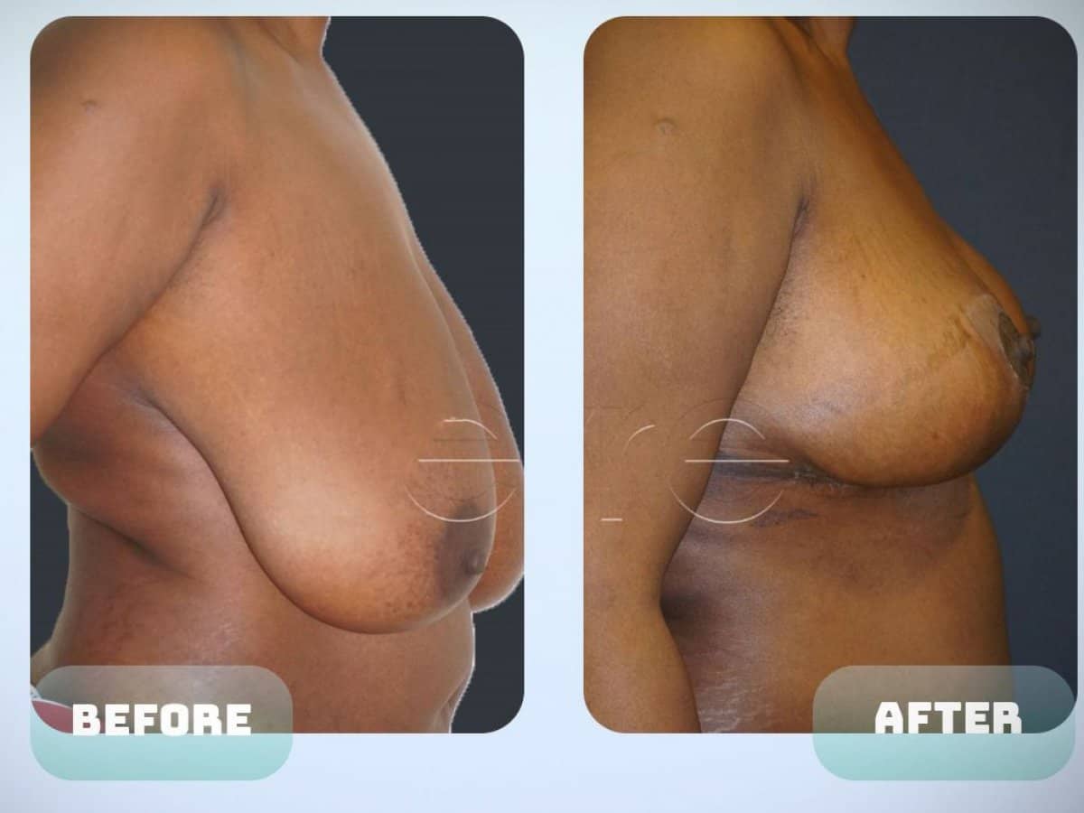 Case 15018 - breast reduction