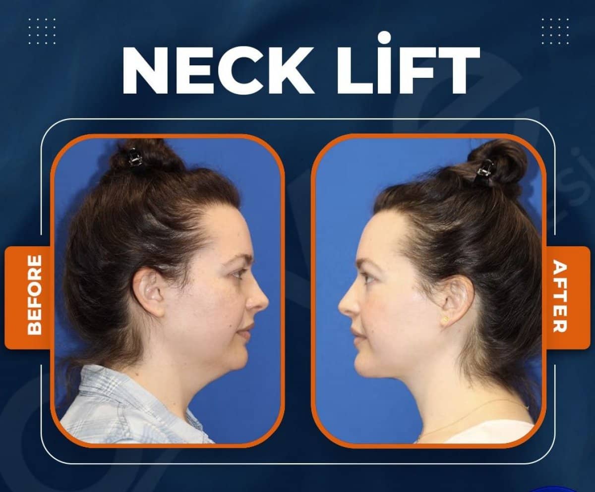 Case 15019 - neck lift