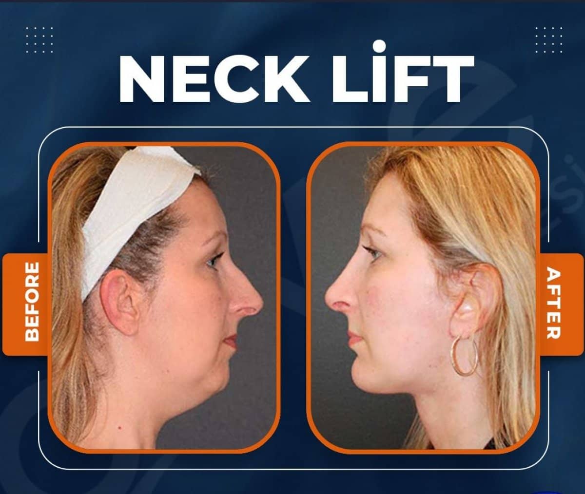 Case 15021 - neck lift