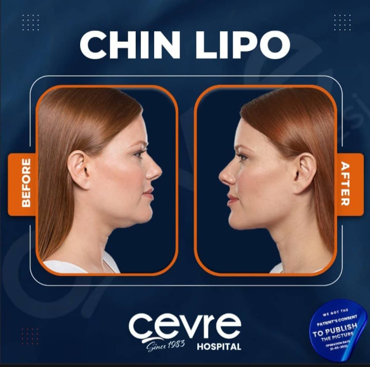 Case 15023 - chin liposuction