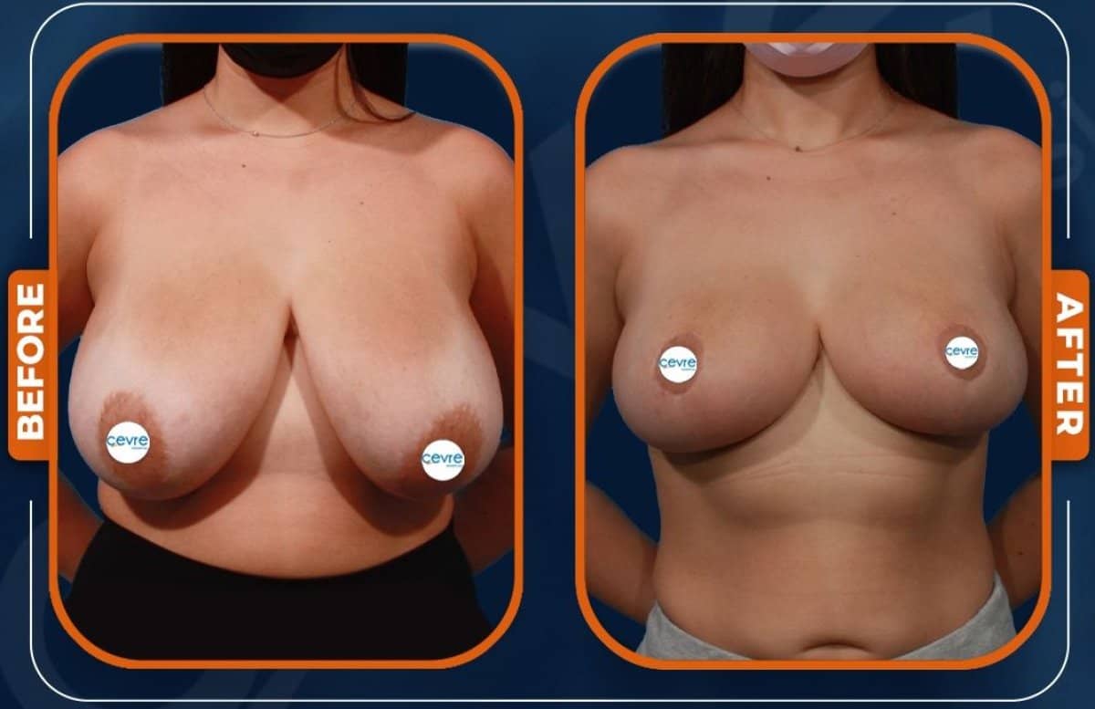 Case 15024 - breast reduction