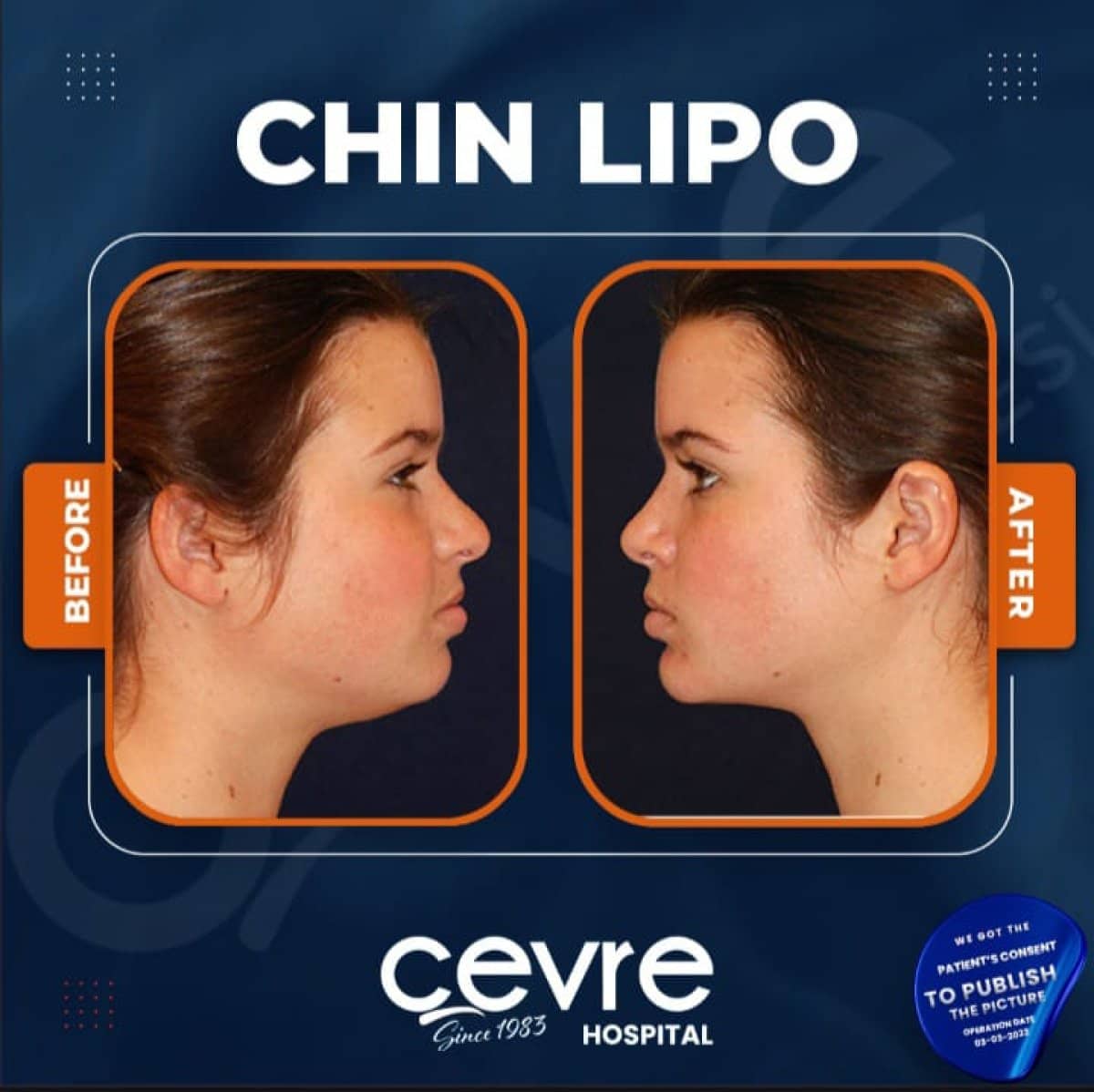 Case 15025 - chin liposuction