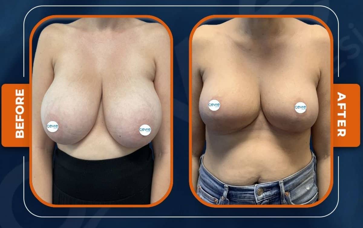 Case 15027 - breast reduction