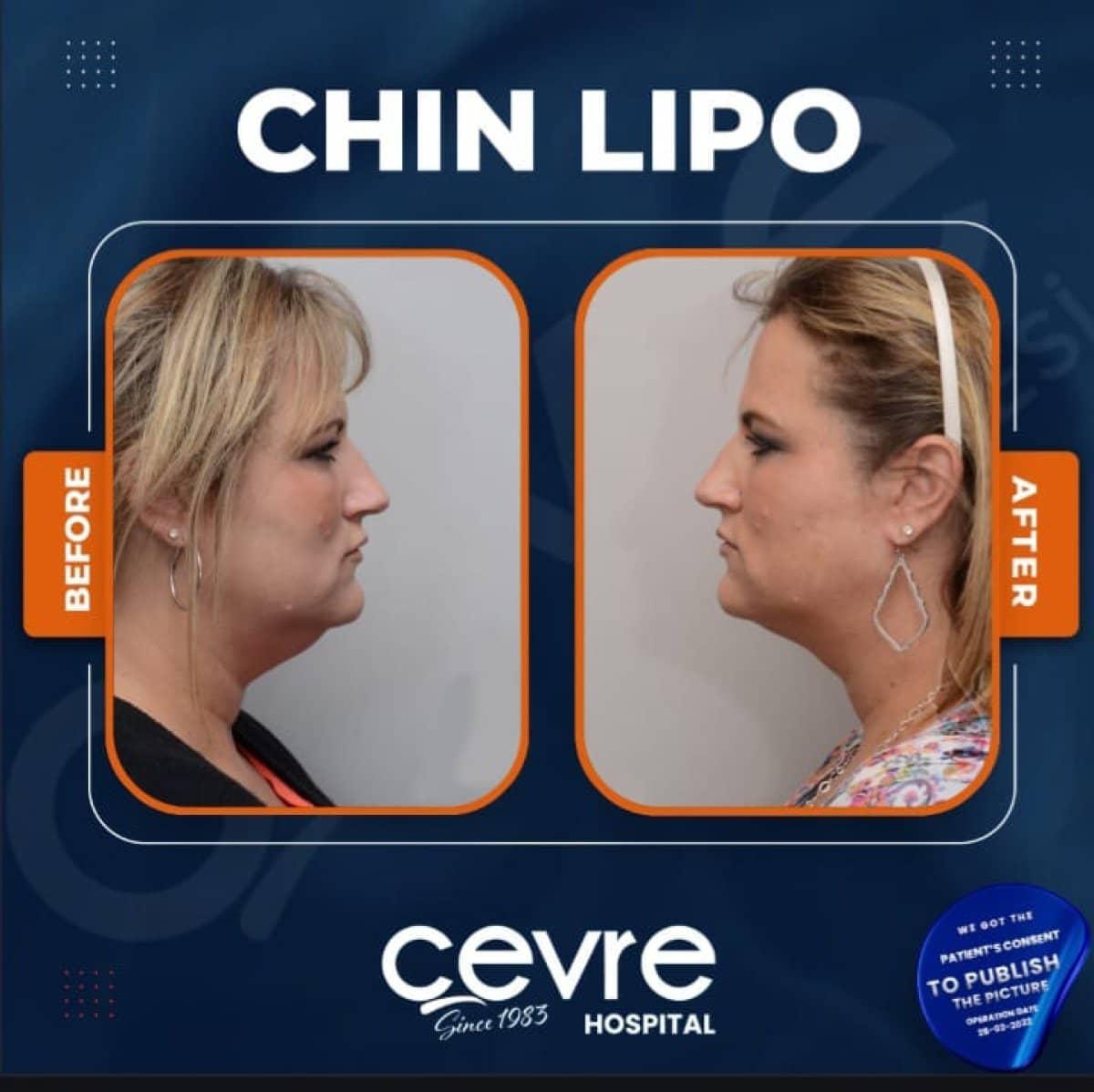 Case 15029 - chin liposuction