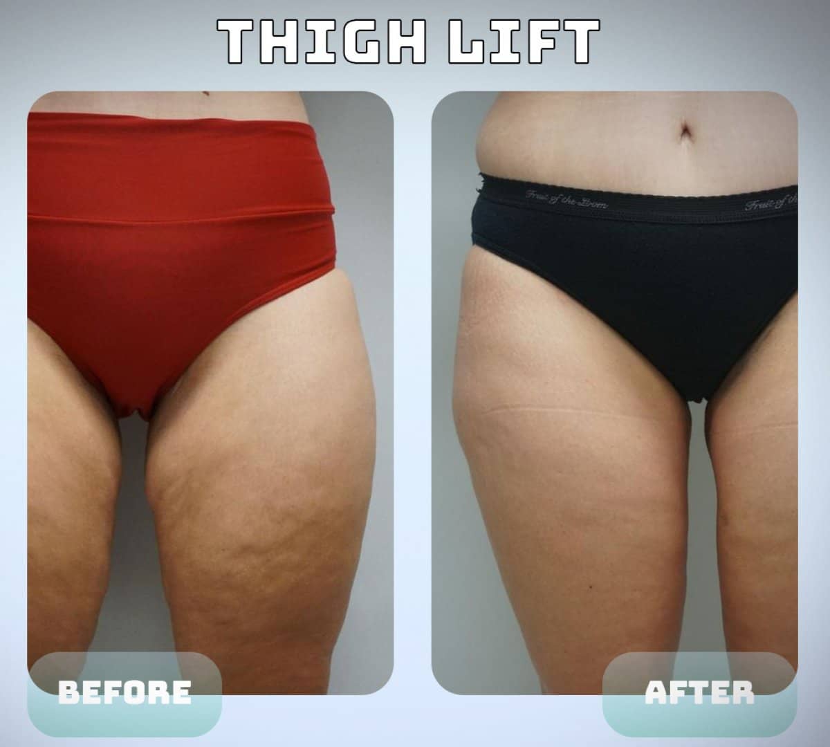 Case 15030 - thigh lift