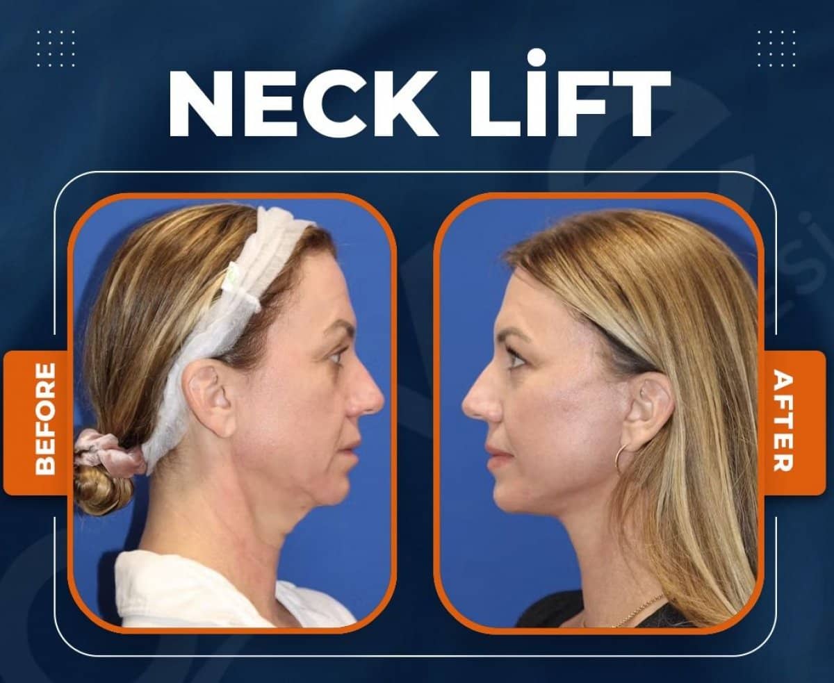 Case 15031 - neck lift