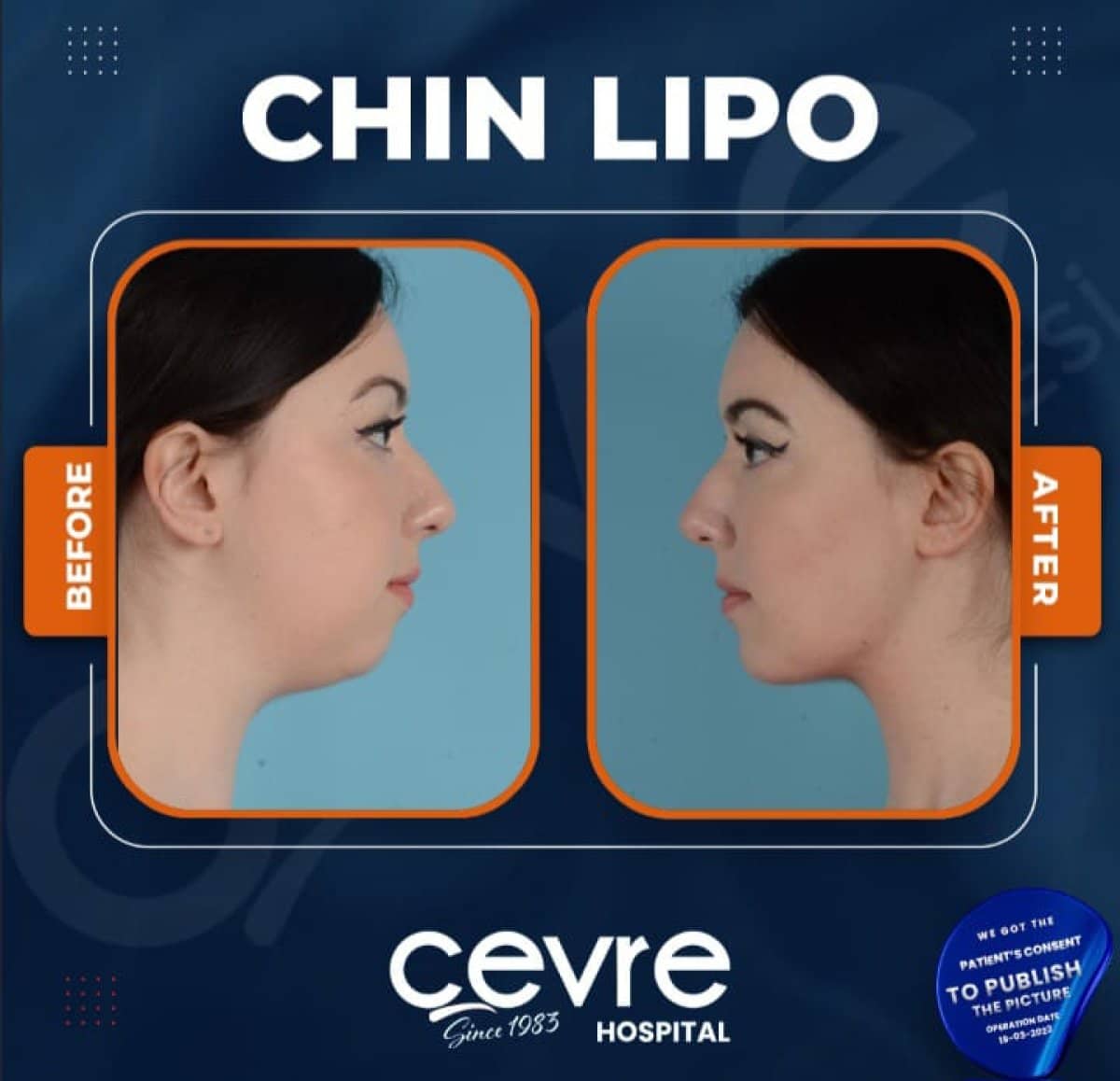 Case 15032 - chin liposuction