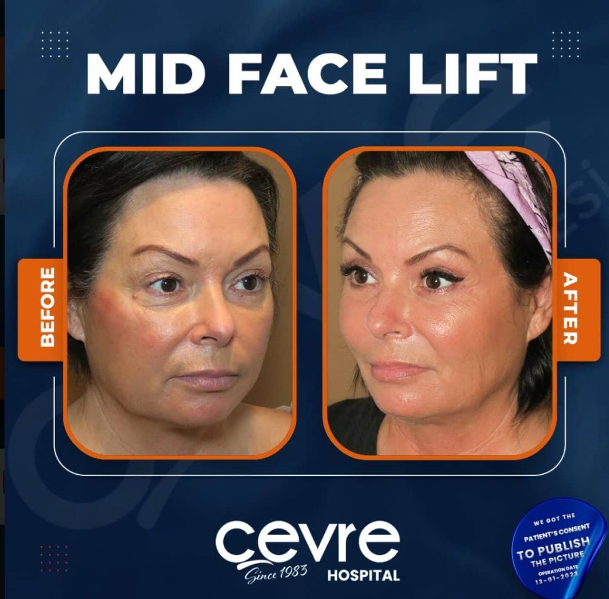 Case 15033 - facelift