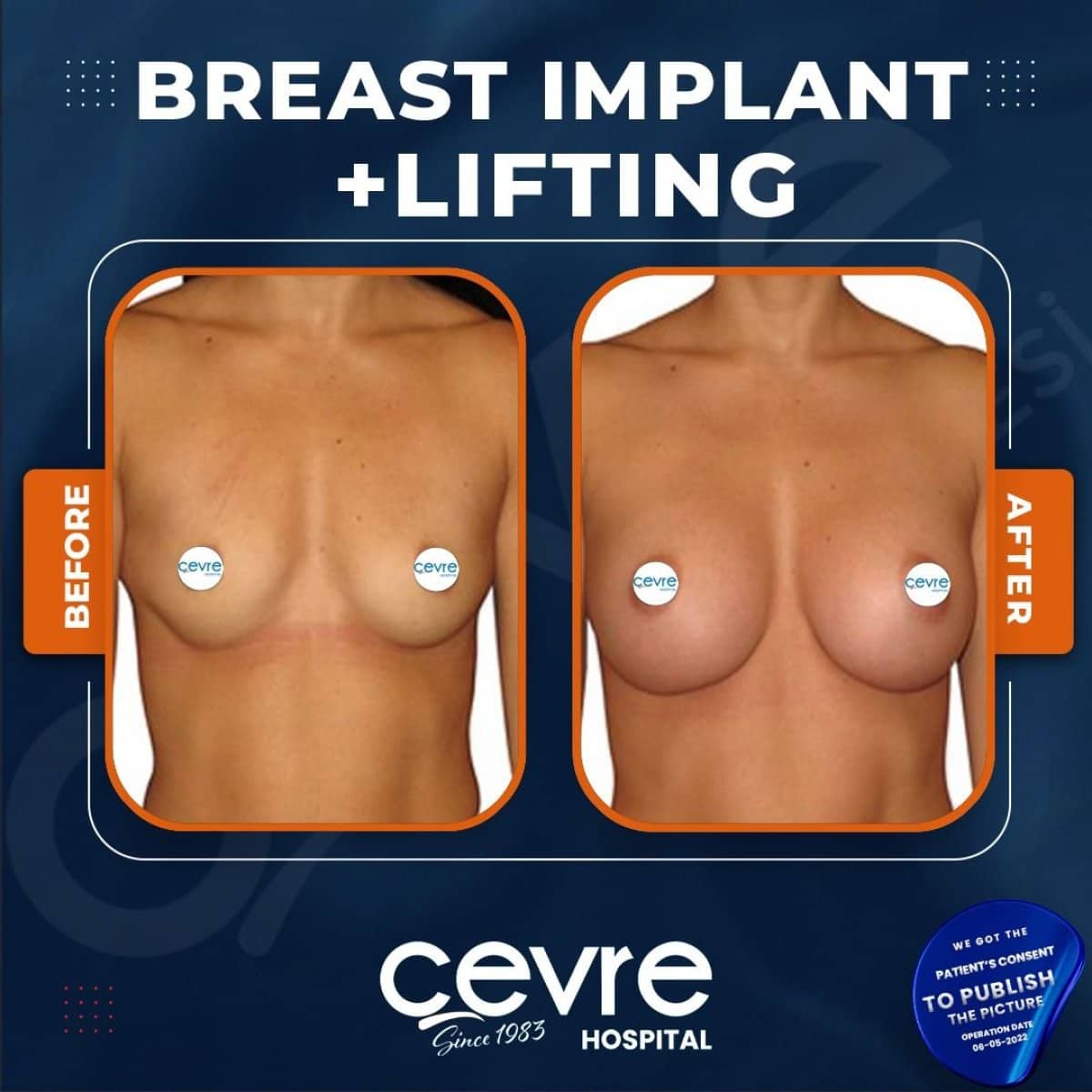 Case 15035 - breast lift and implant