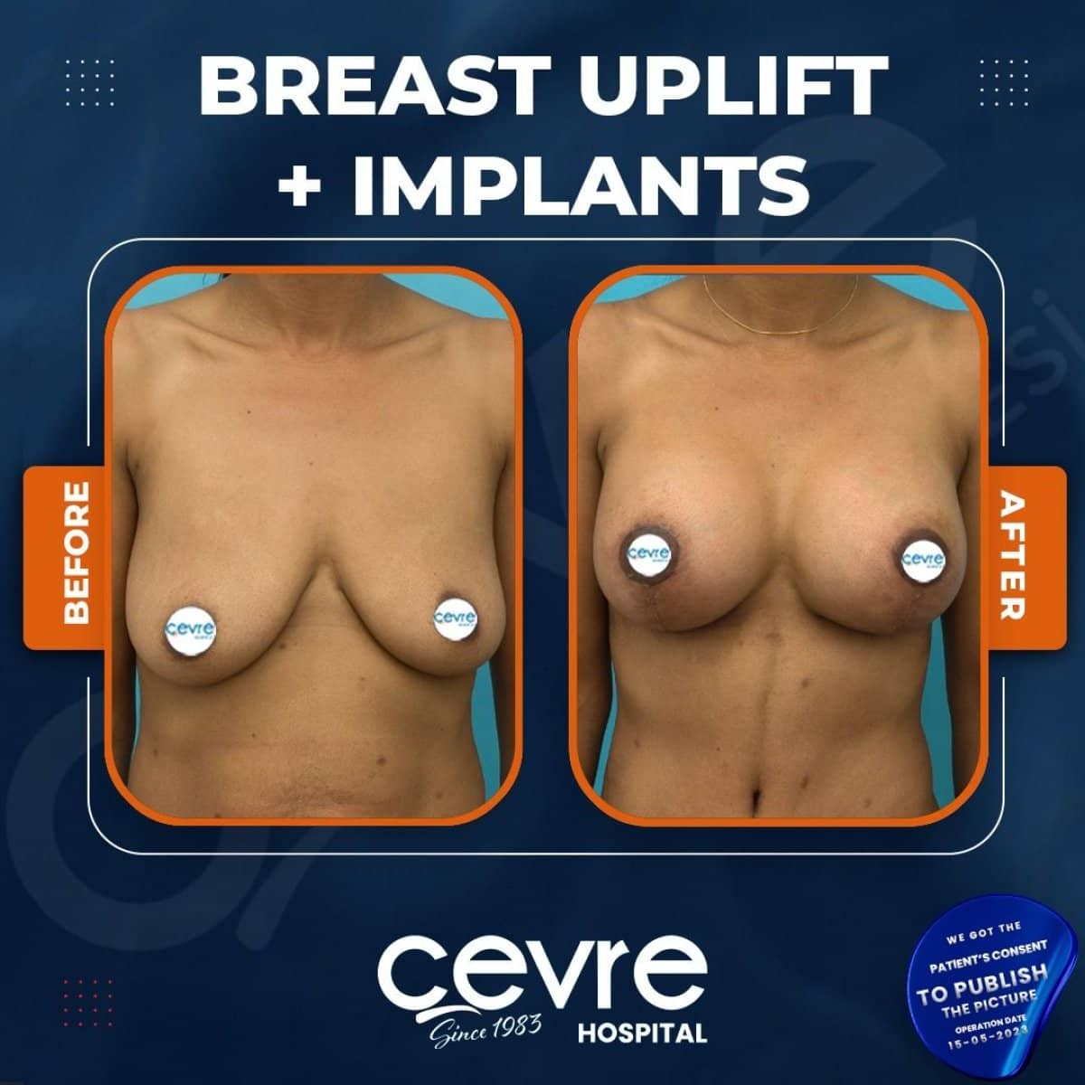 Case 15036 - breast lift