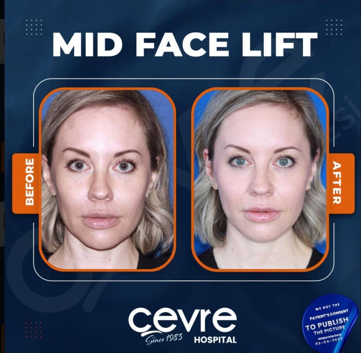 Case 15037 - facelift