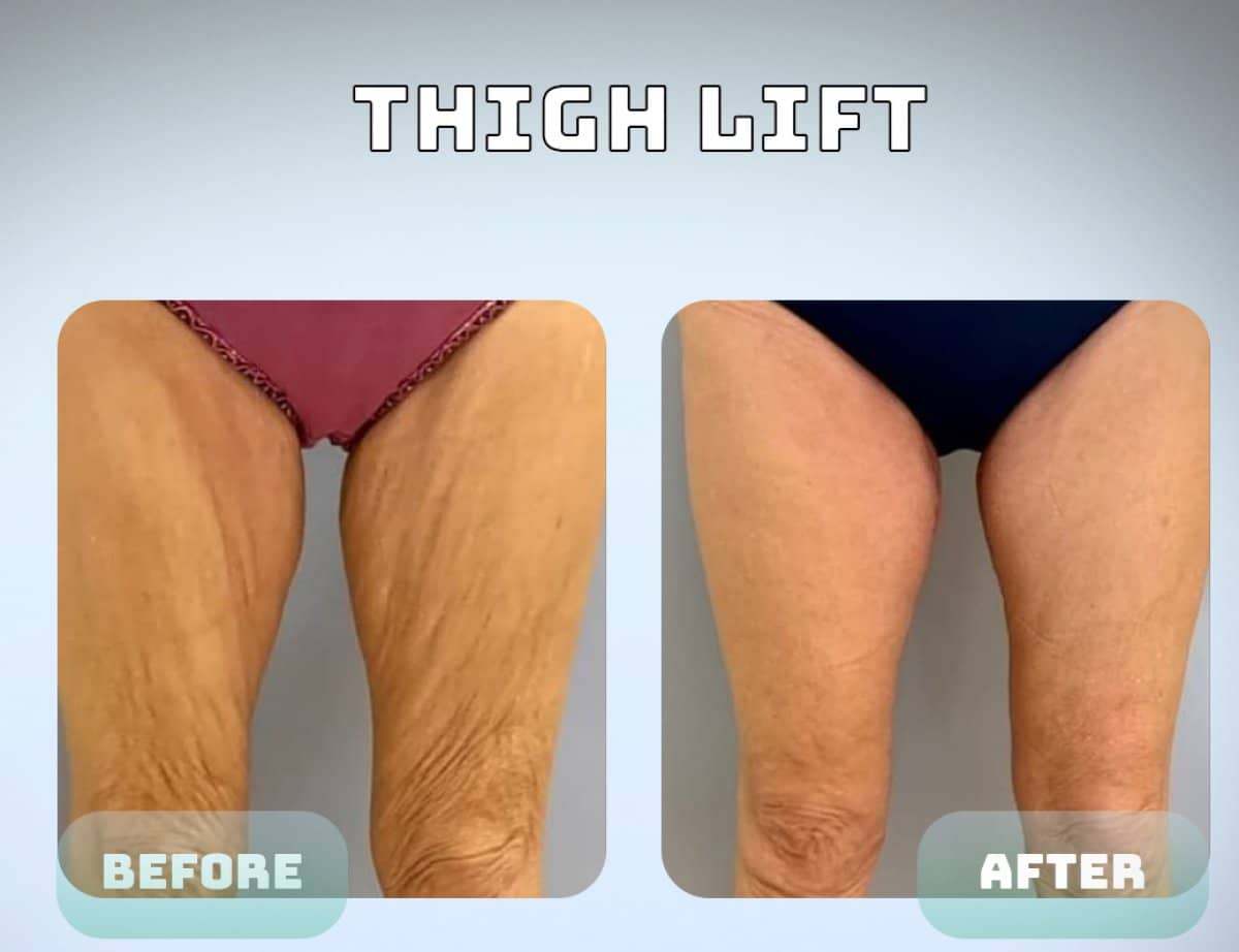 Case 15039 - thigh lift
