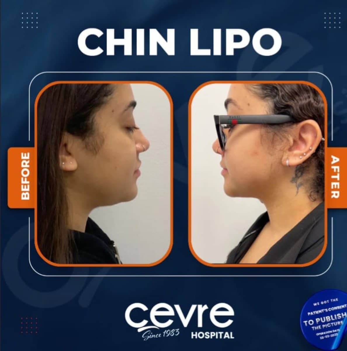 Case 15043 - chin liposuction