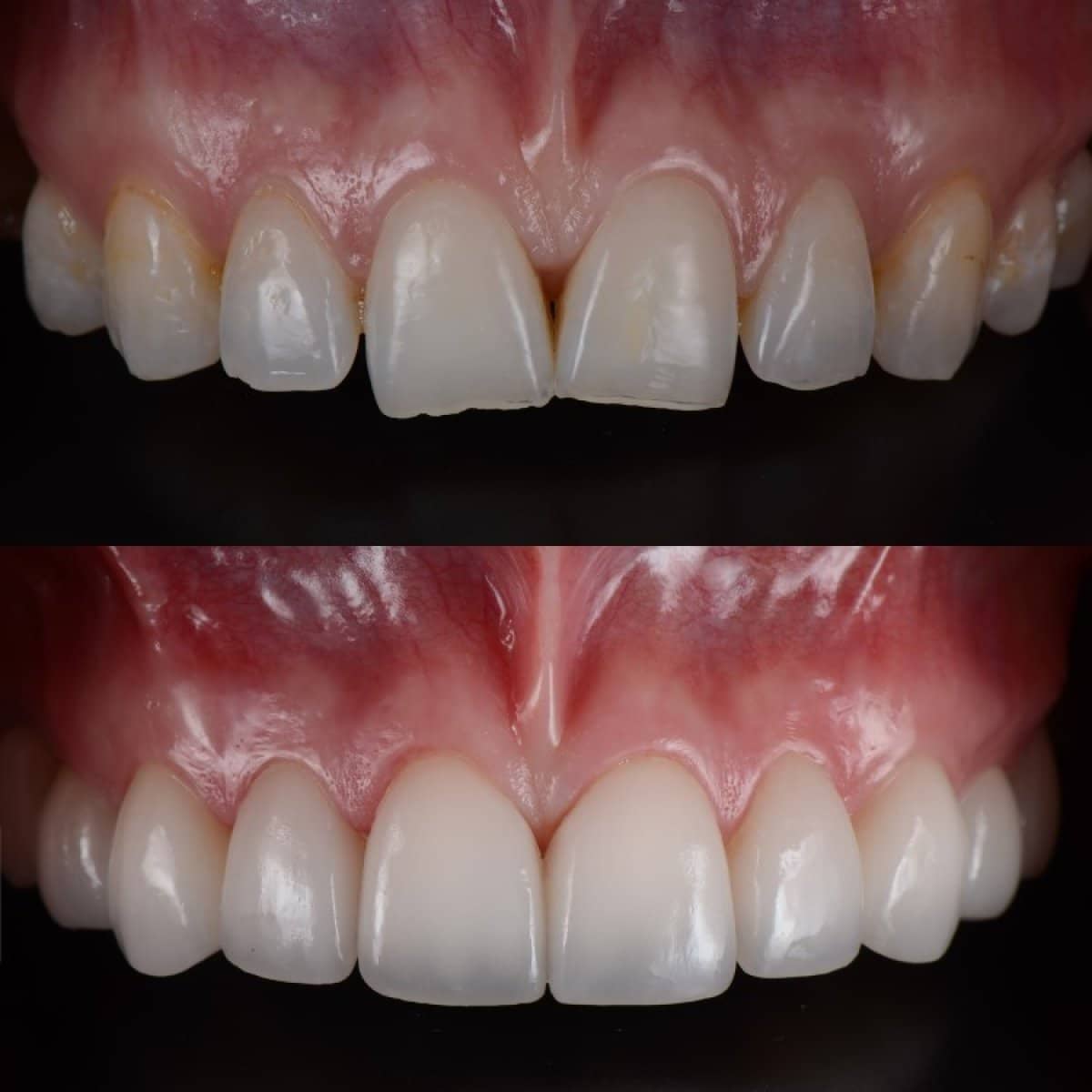 Case 15044 - composite veneer
