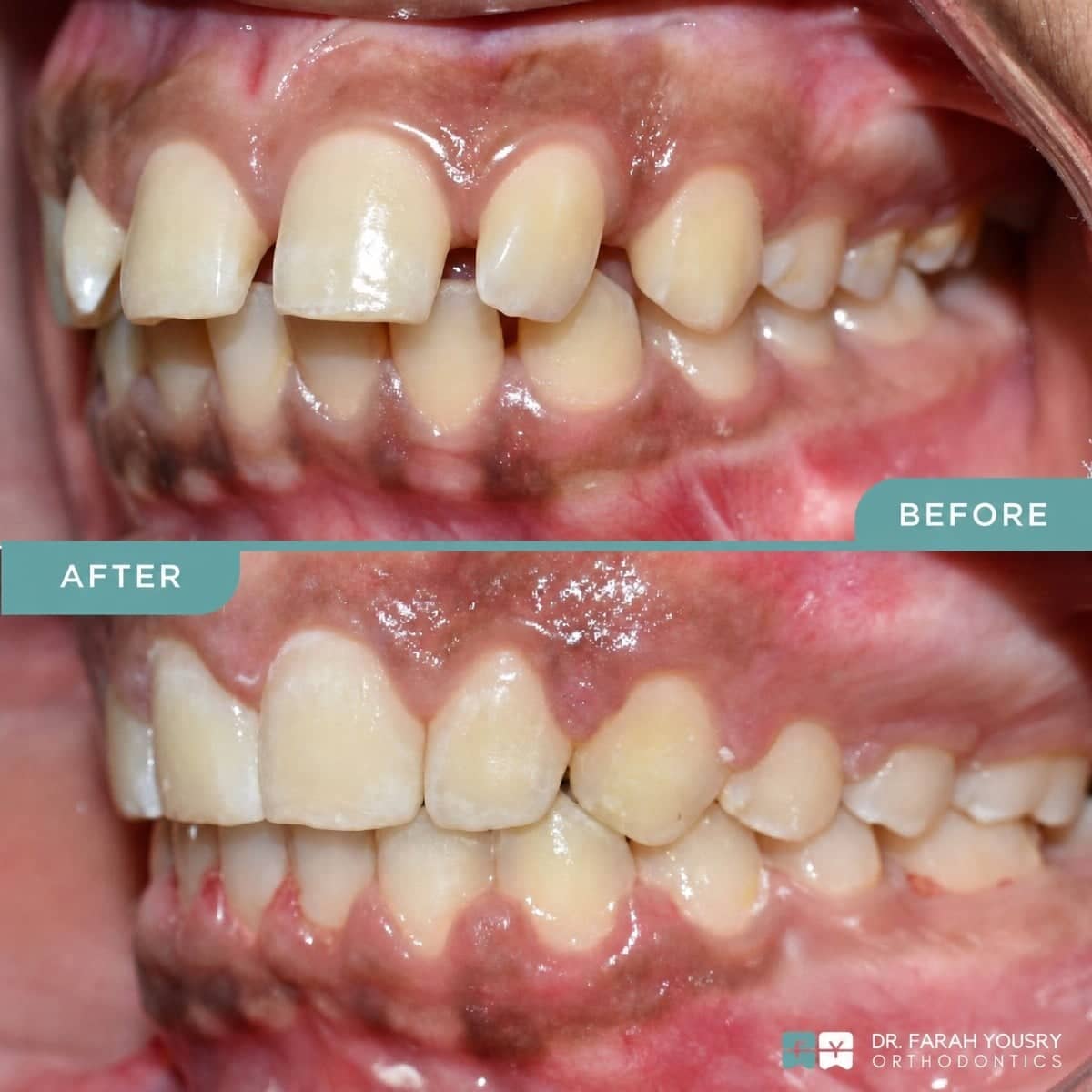 Case 15084 - clear aligners