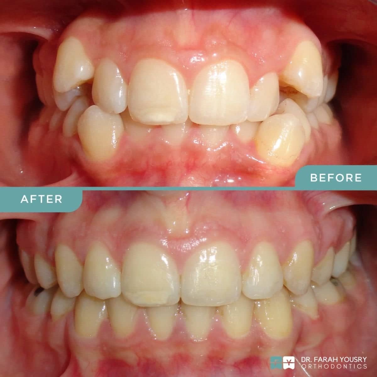 Case 15086 - clear aligners