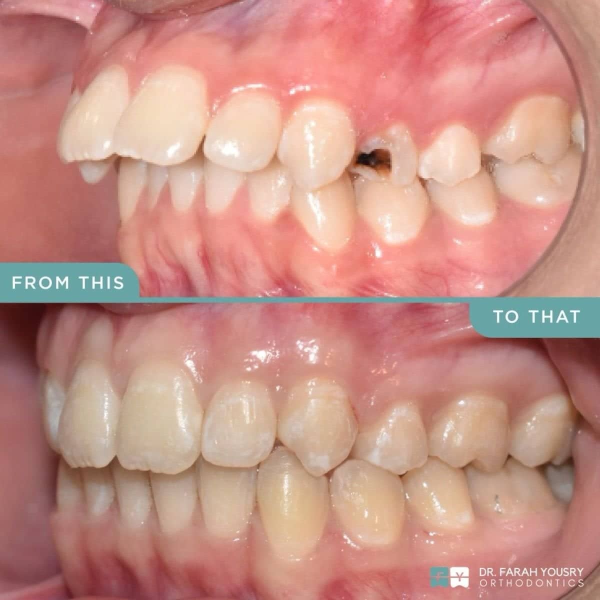 Case 15088 - clear aligners