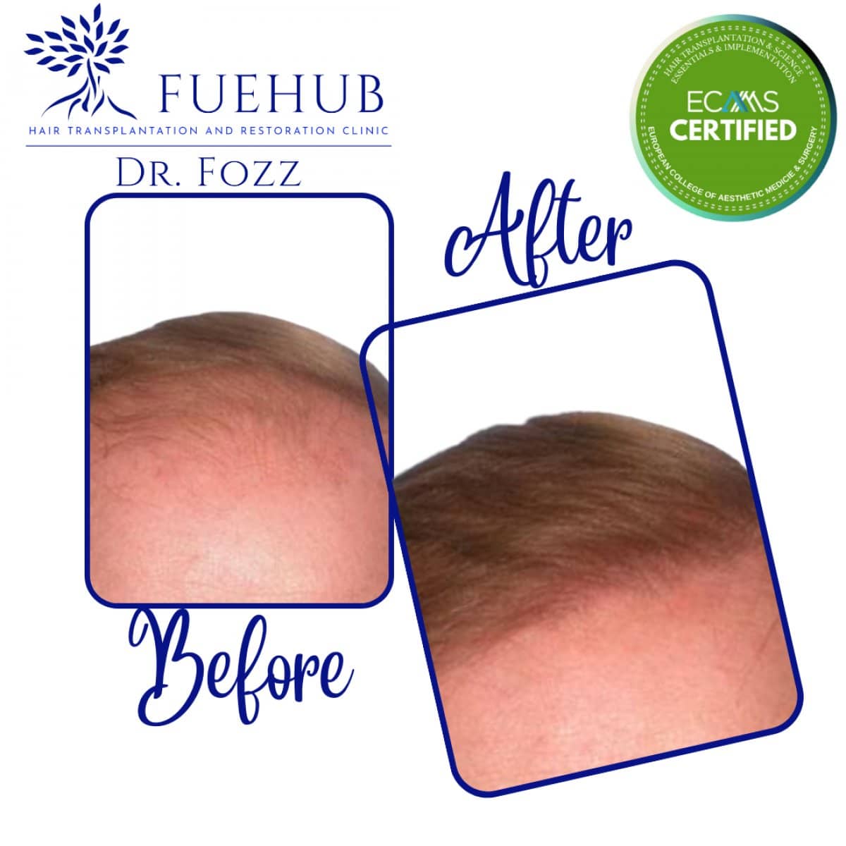 Case 15091 - FUE hair transplant