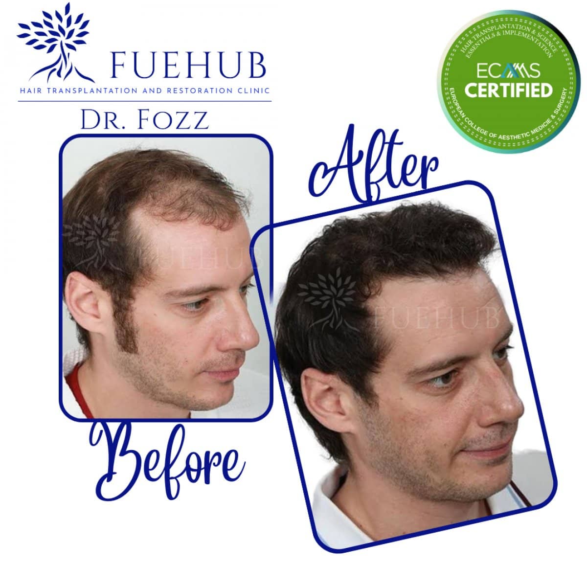 Case 15092 - DHI hair transplant