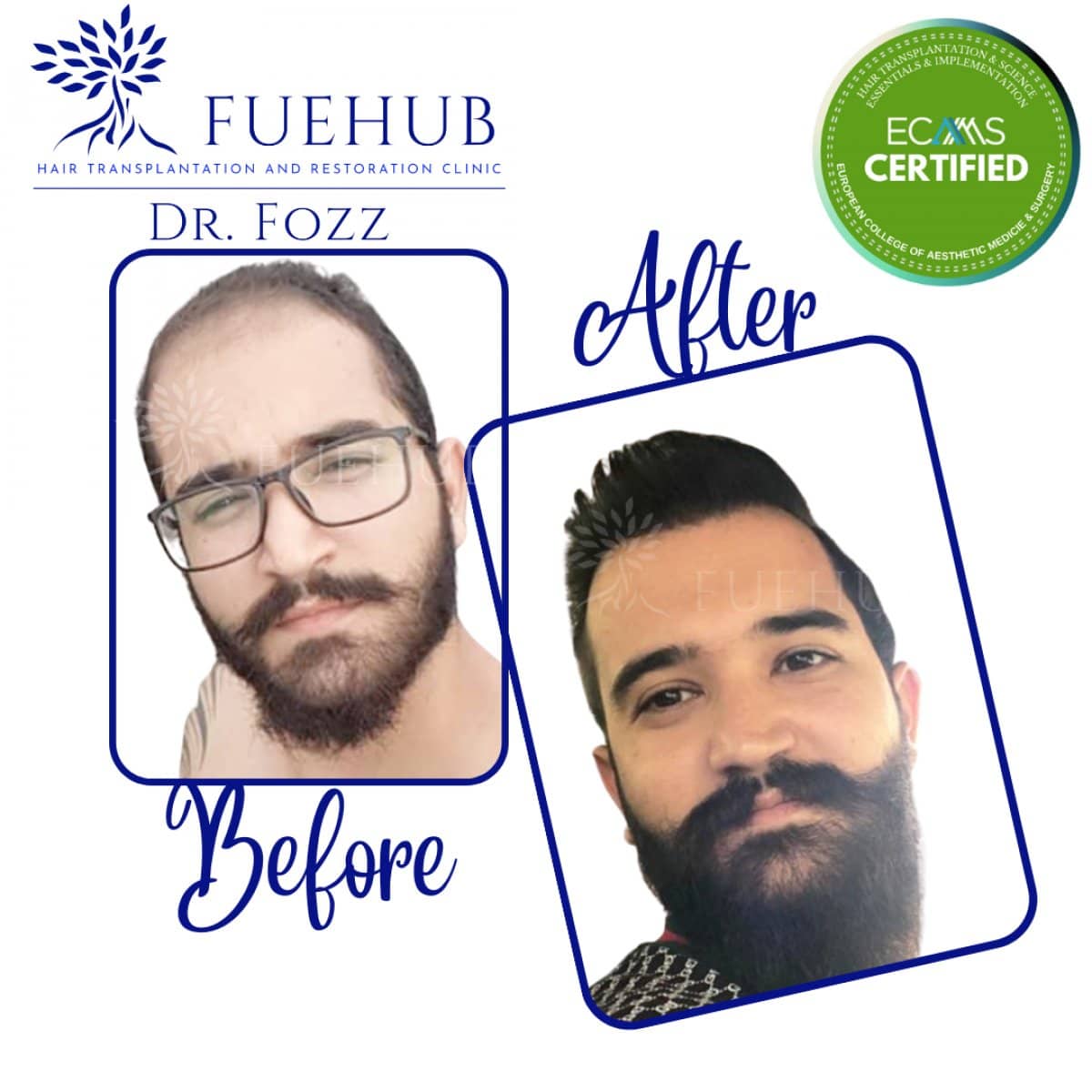 Case 15094 - FUE hair transplant