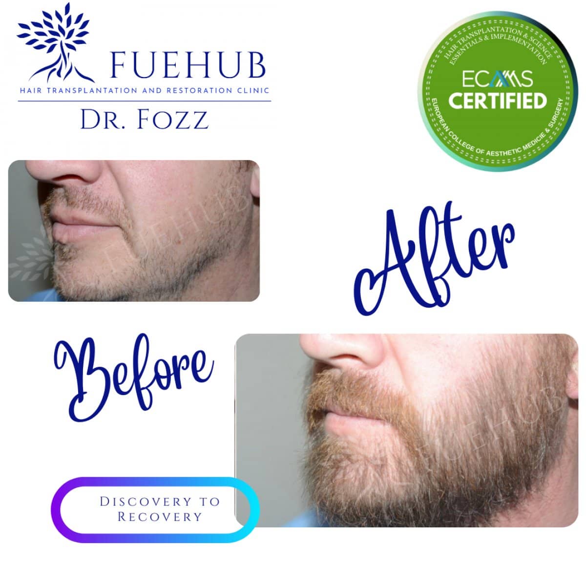 Case 15095 - beard FUE hair transplant