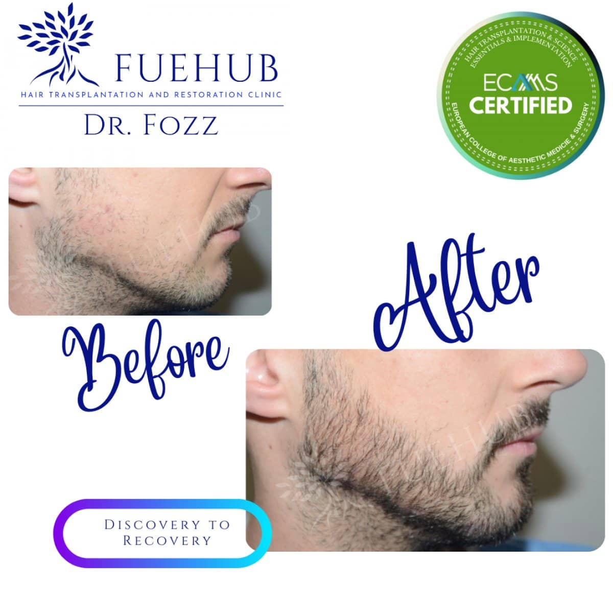 Case 15096 - beard transplant