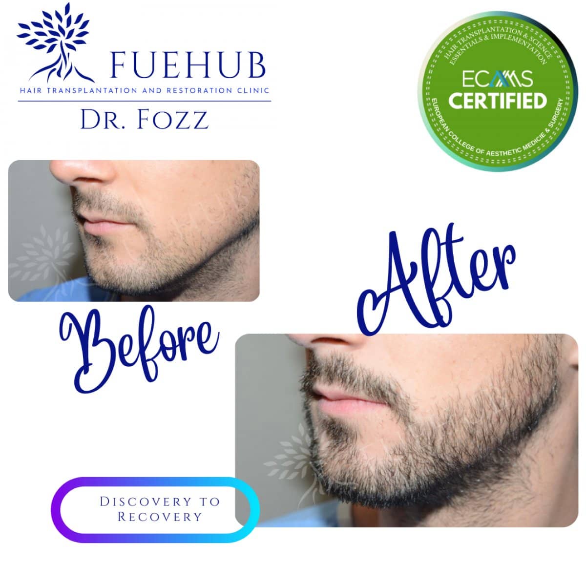 Case 15097 - beard transplant