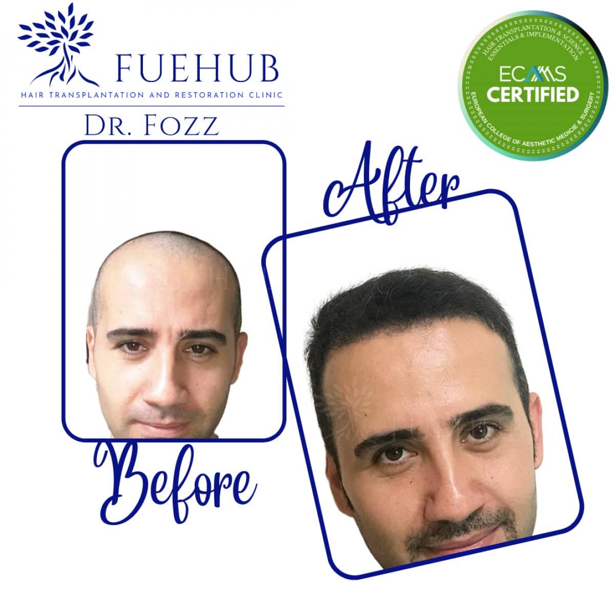 Case 15098 - FUE hair transplant