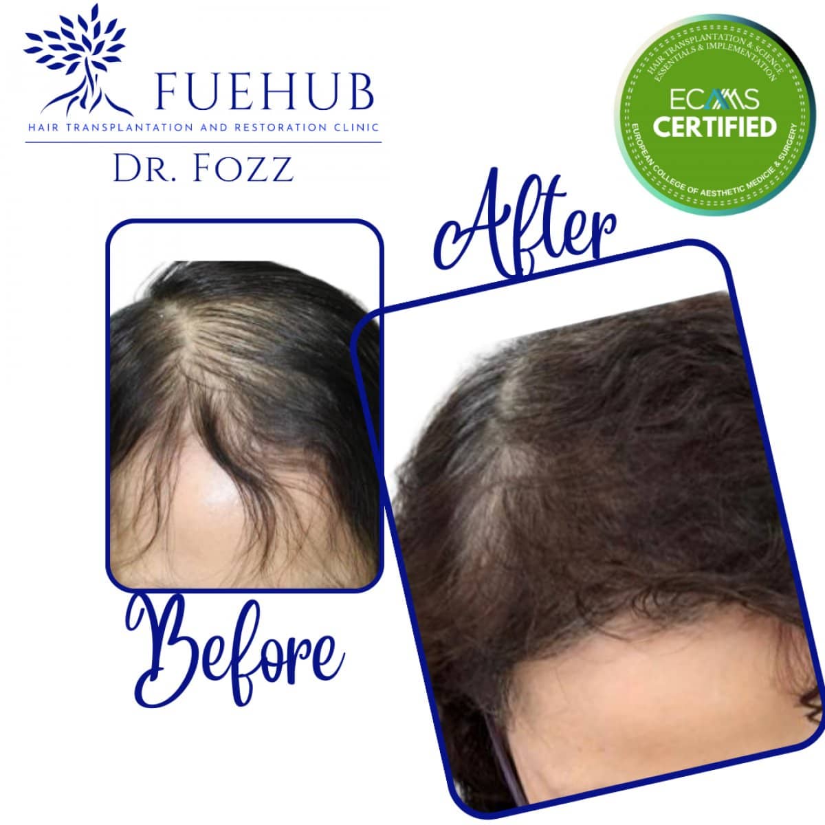 Case 15099 - female hair transplant