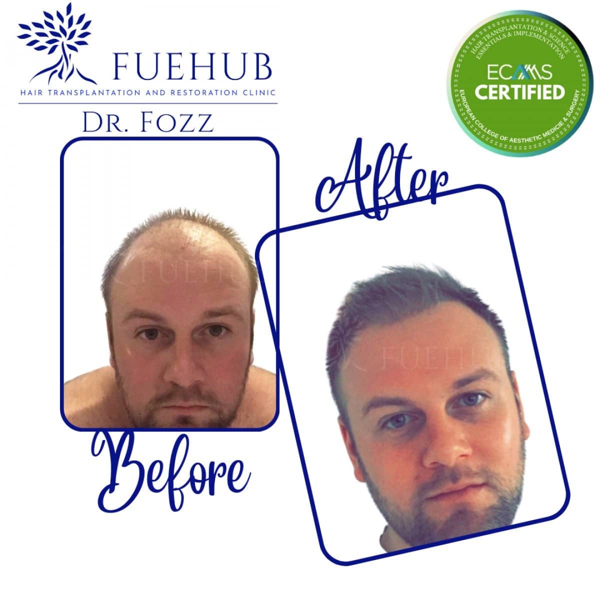 Case 15100 - FUE hair transplant