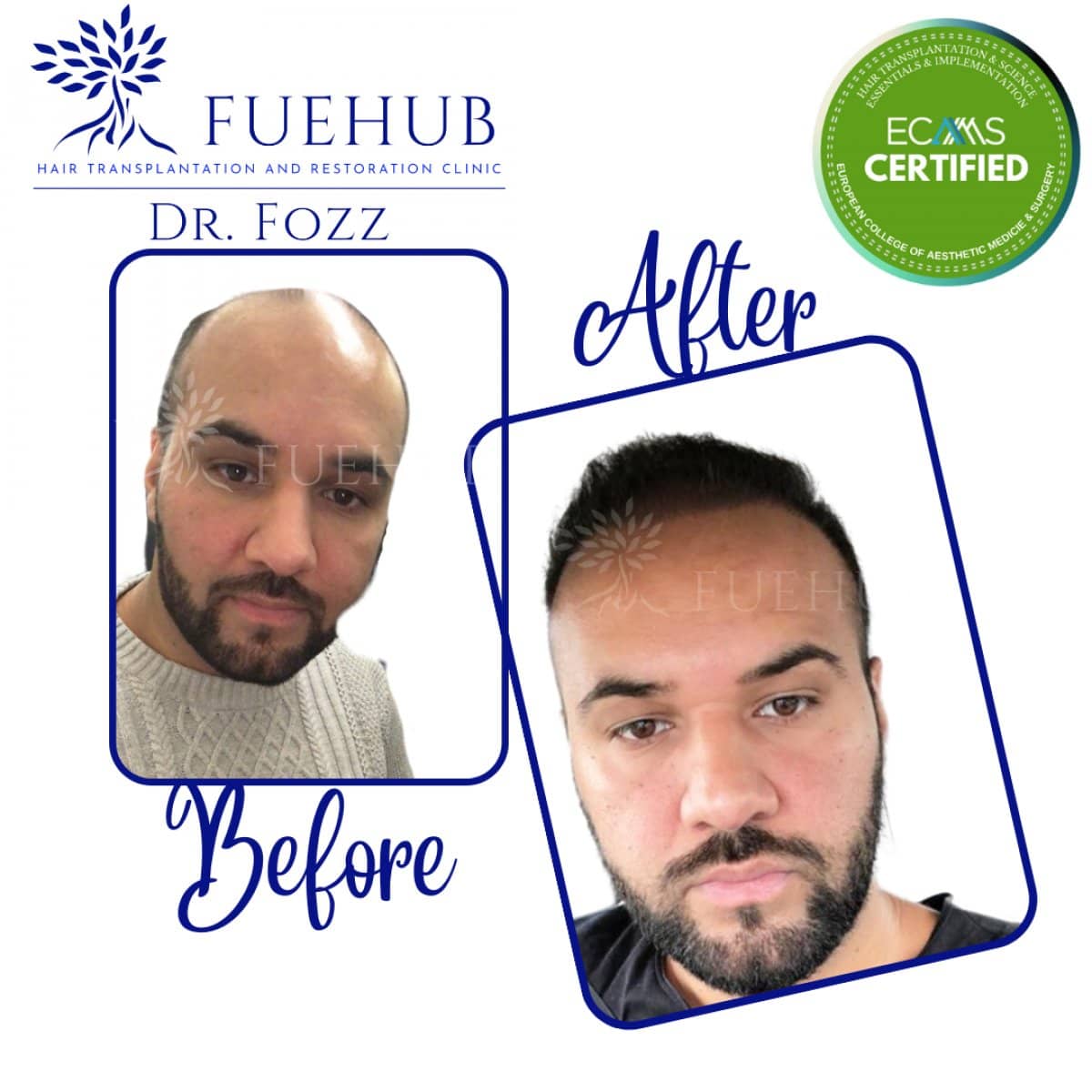 Case 15101 - FUE hair transplant