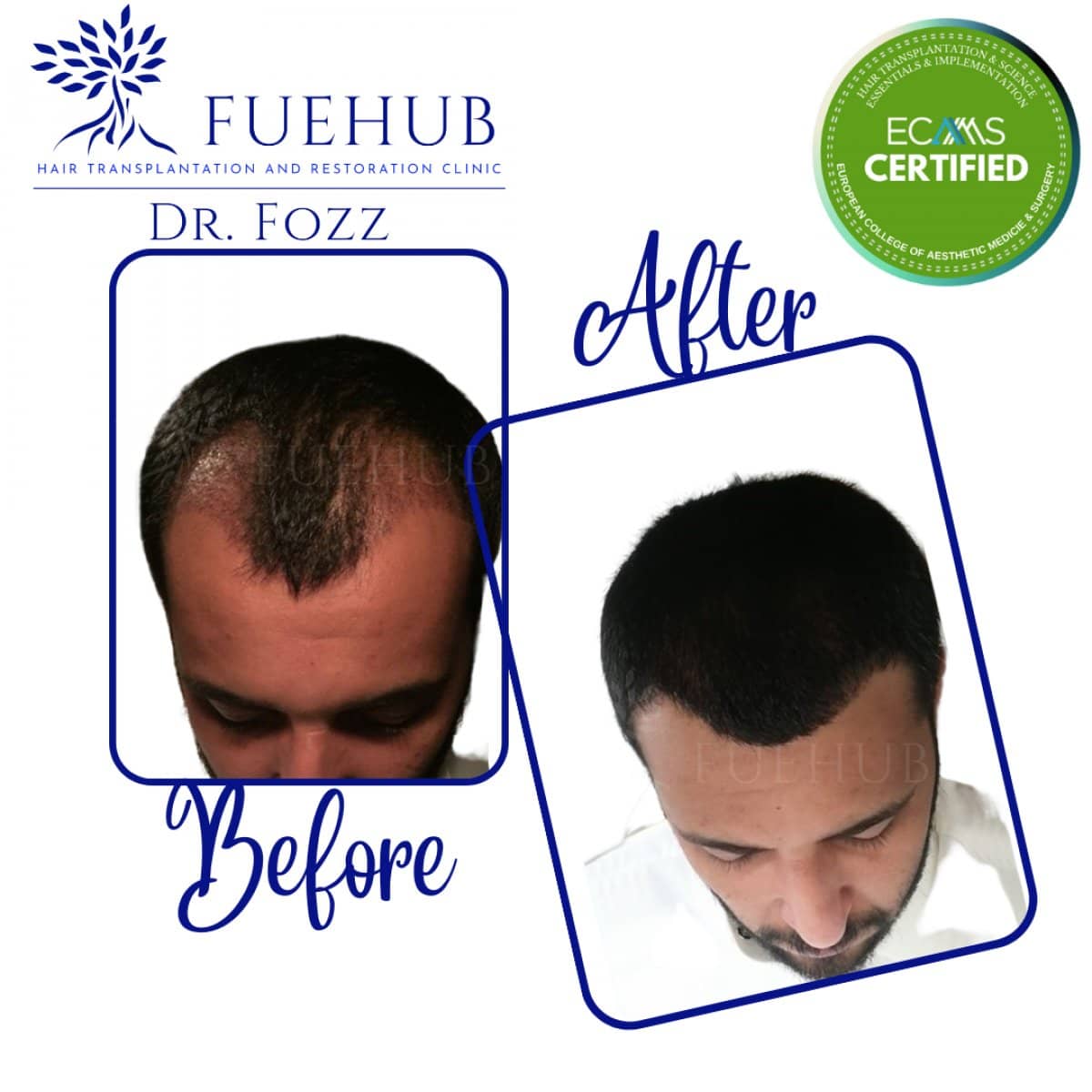 Case 15102 - FUE hair transplant