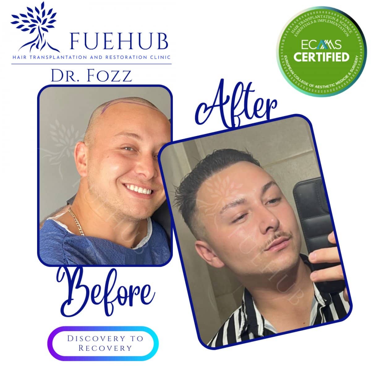Case 15103 - FUE hair transplant