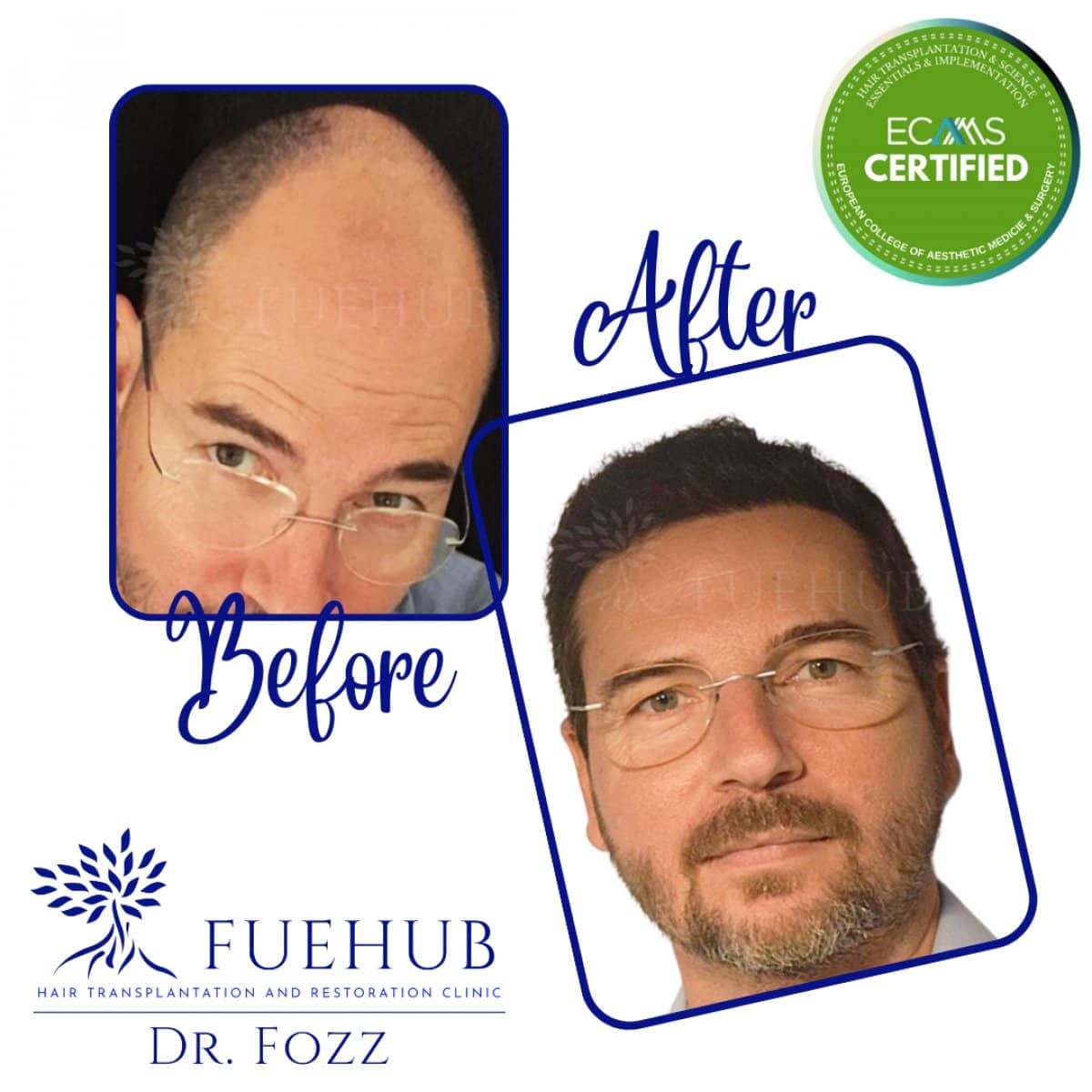 Case 15104 - DHI hair transplant