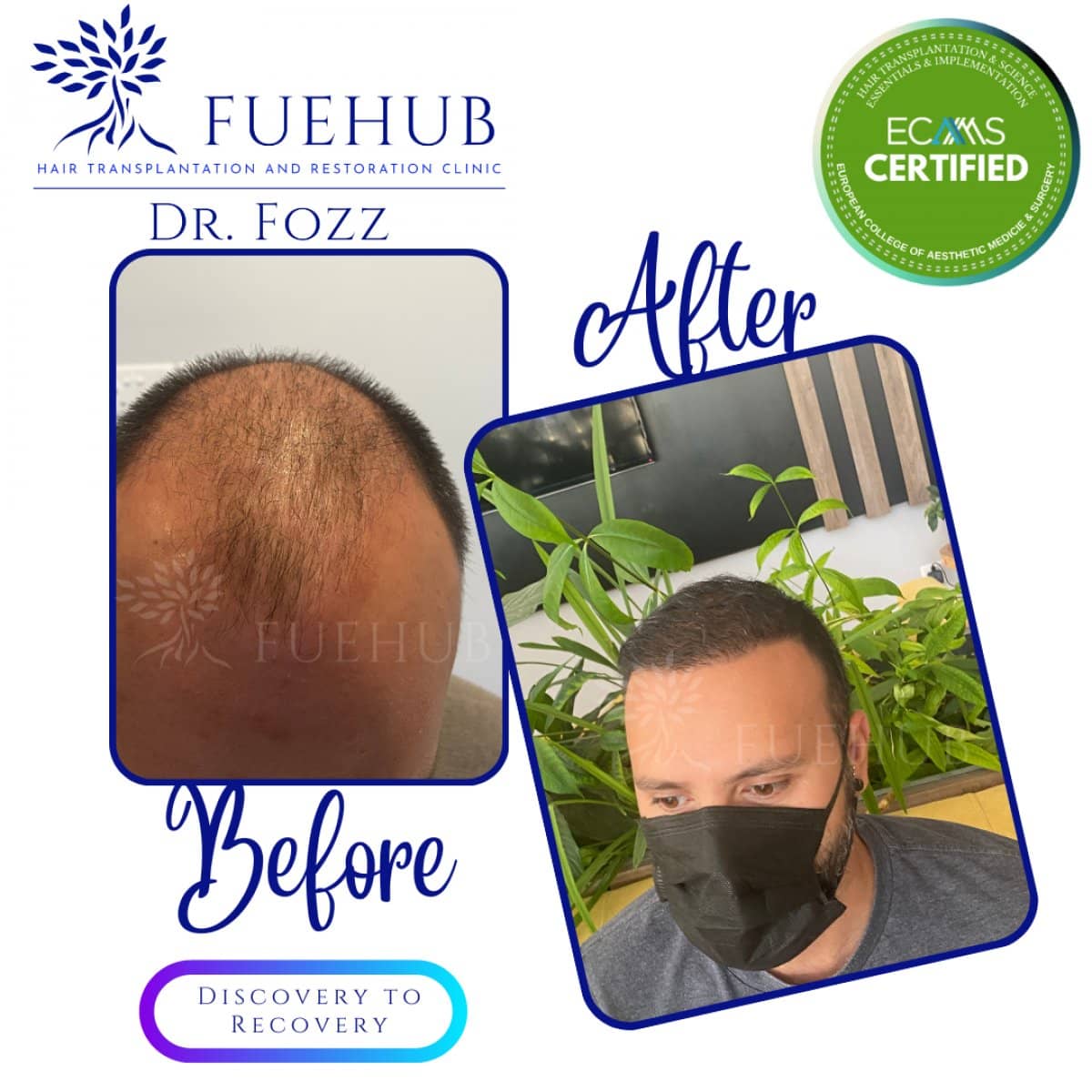 Case 15105 - FUE hair transplant
