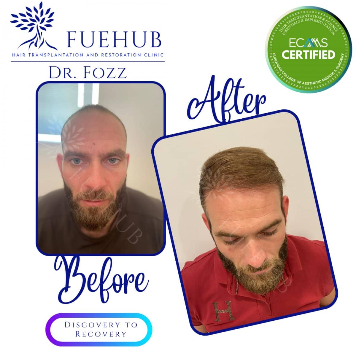 Case 15106 - FUE hair transplant