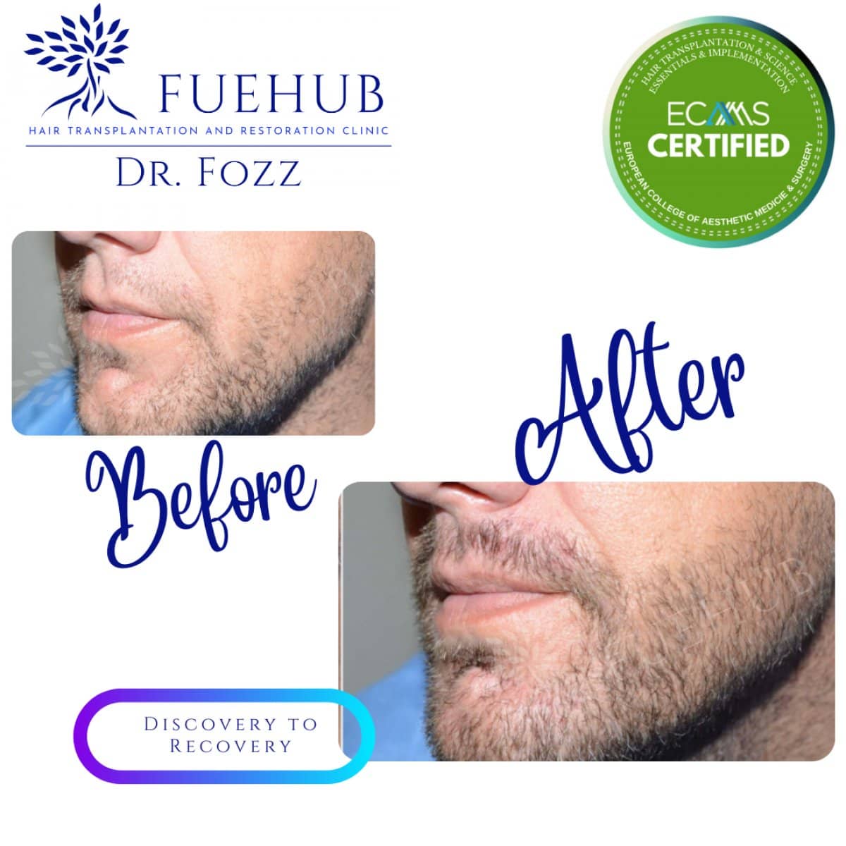 Case 15107 - beard transplant