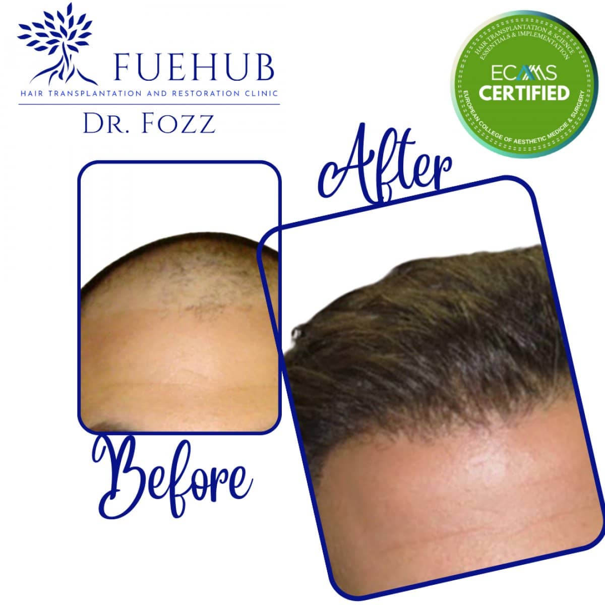 Case 15108 - FUE hair transplant