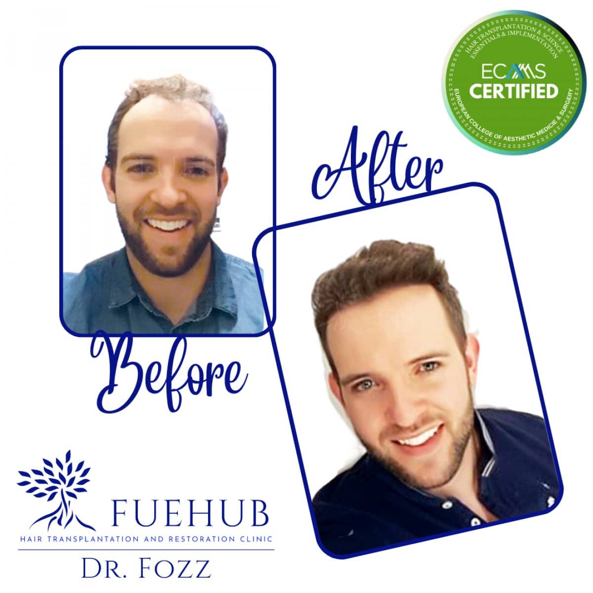 Case 15112 - FUE hair transplant