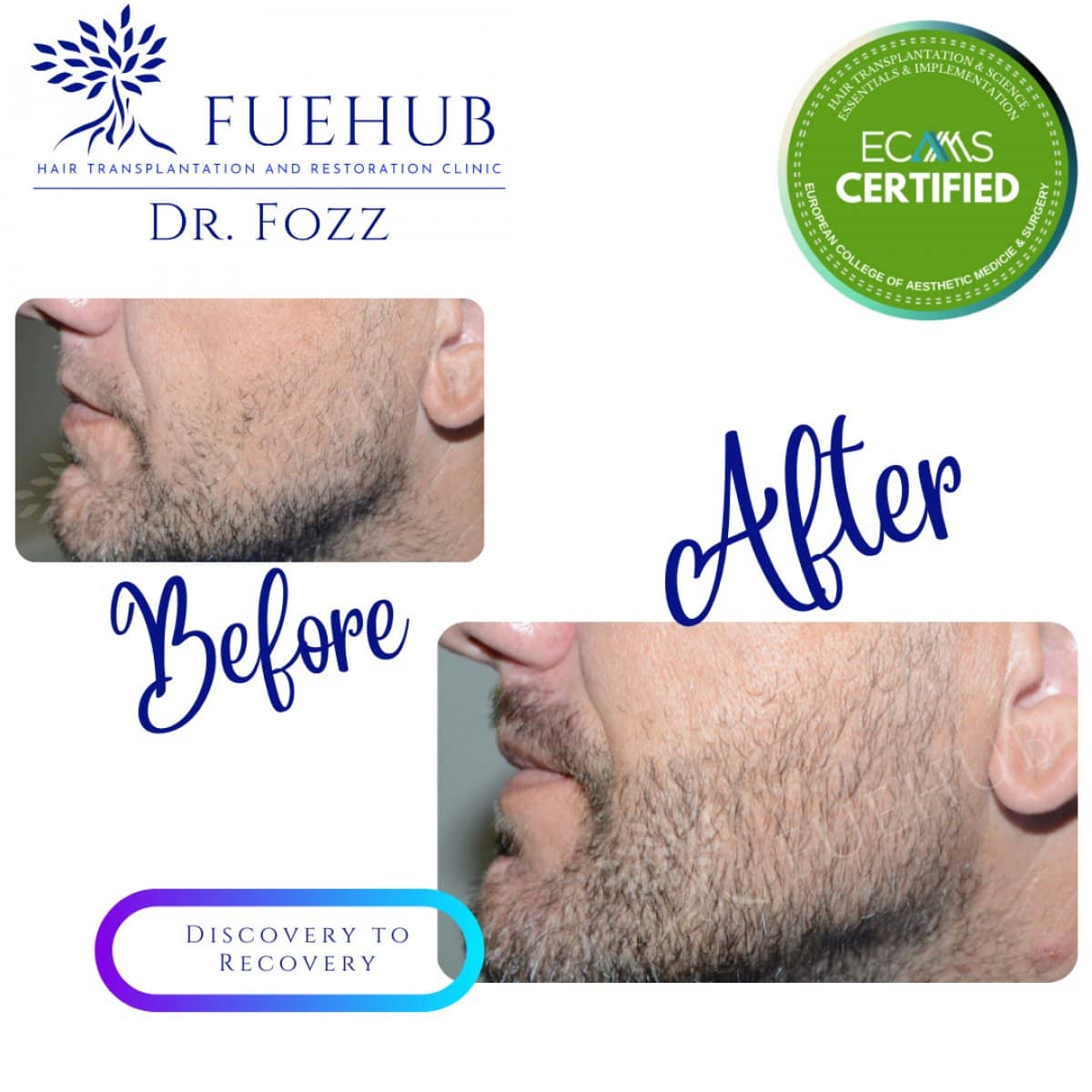 Case 15113 - beard transplant