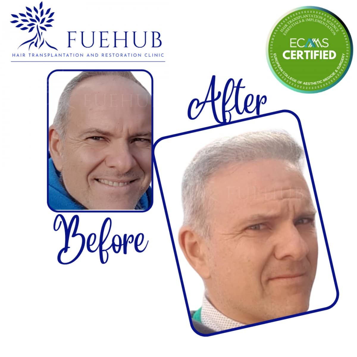 Case 15115 - FUE hair transplant
