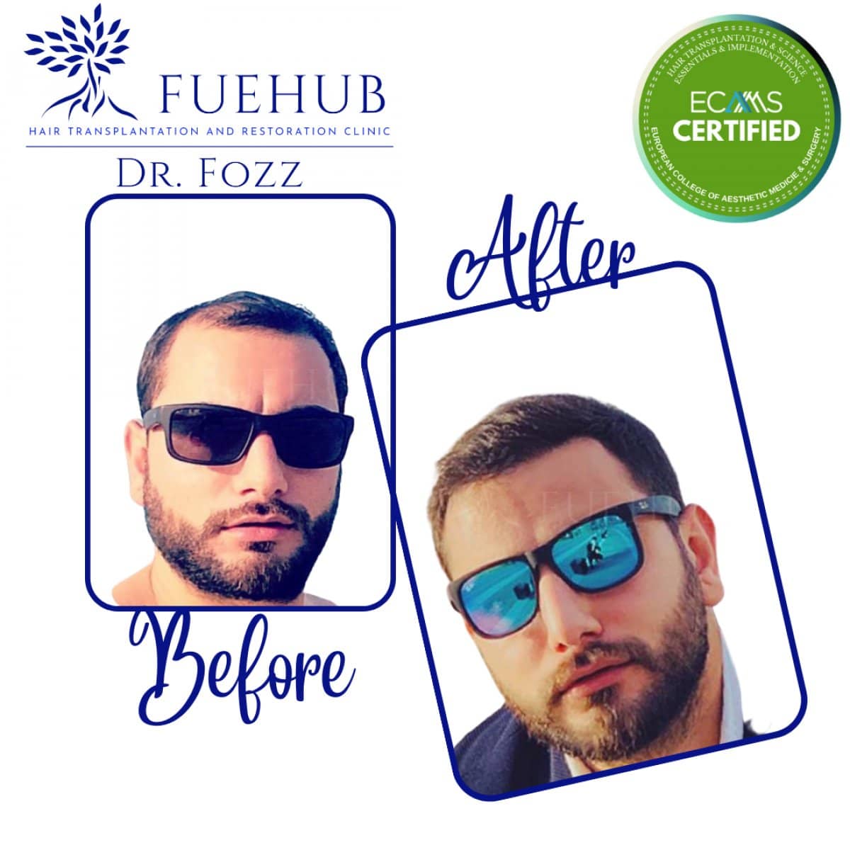 Case 15119 - FUE hair transplant