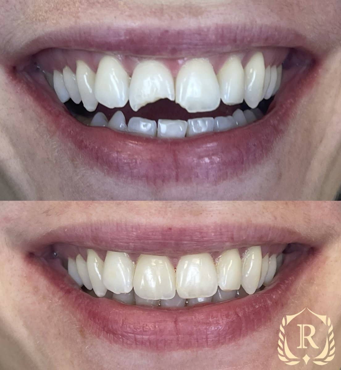 Case 15189 - smile makeover
