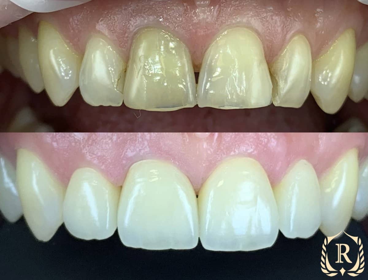 Case 15190 - smile makeover