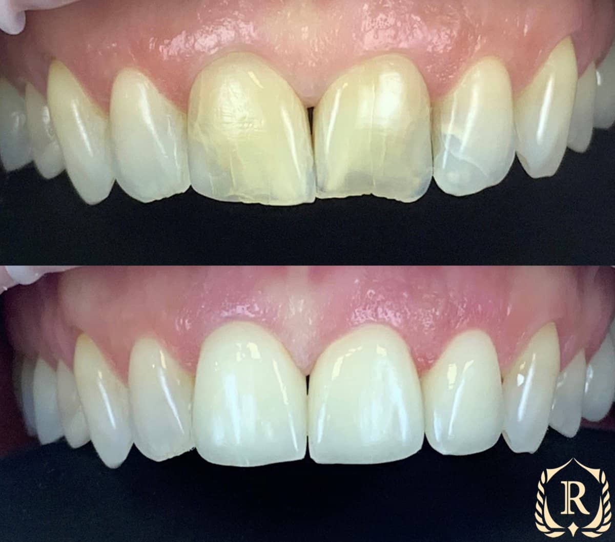 Case 15192 - smile makeover