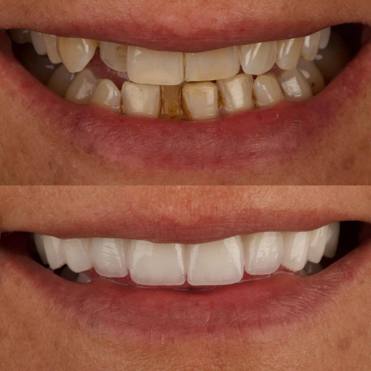 Case 15271 - veneers