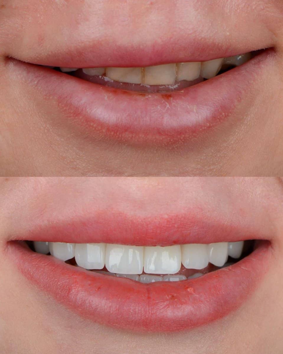 Case 15272 - veneers