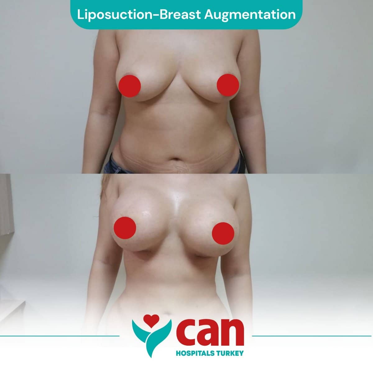 Case 15365 - breast augmentation and liposuction