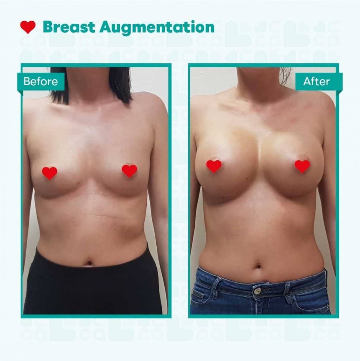 Case 15366 - breast augmentation