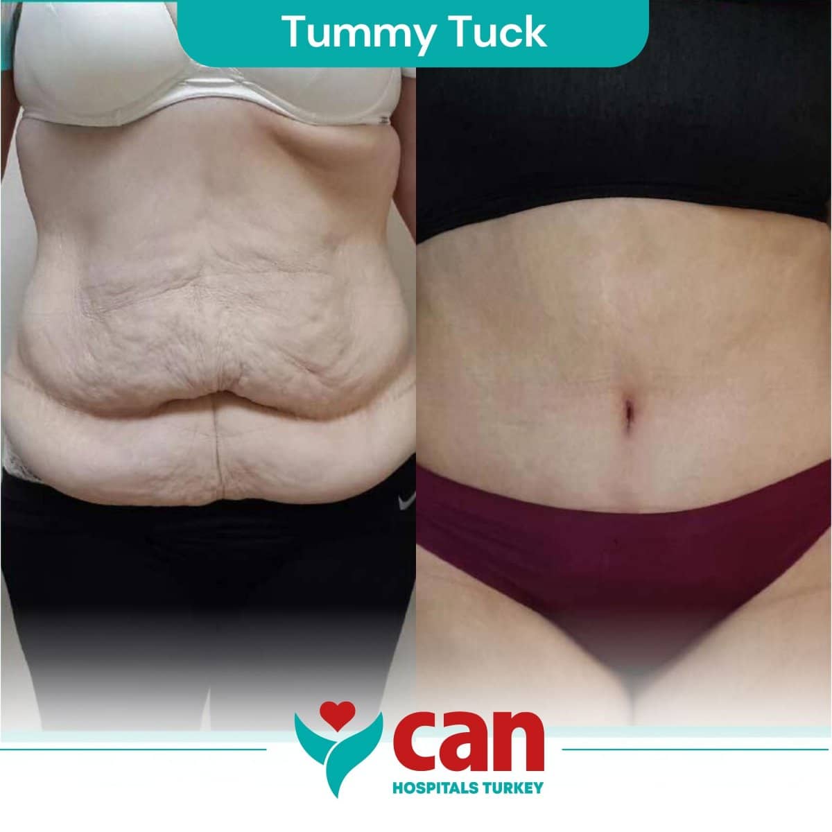Case 15372 - tummy tuck